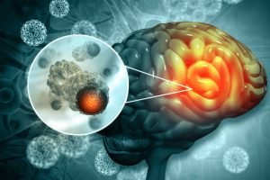 Brain cancer treatment in India
