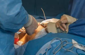 Mastectomy Cost in India