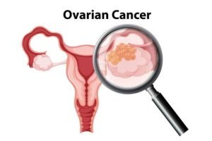 Ovarian cancer treatment in India