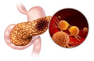 Pancreatic cancer treatment in India