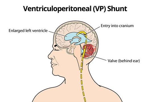 VP Shunt Medicstreet VP Shunt Medicstreet